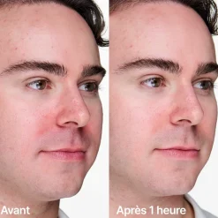 Anti-blemish Solutions Clinical